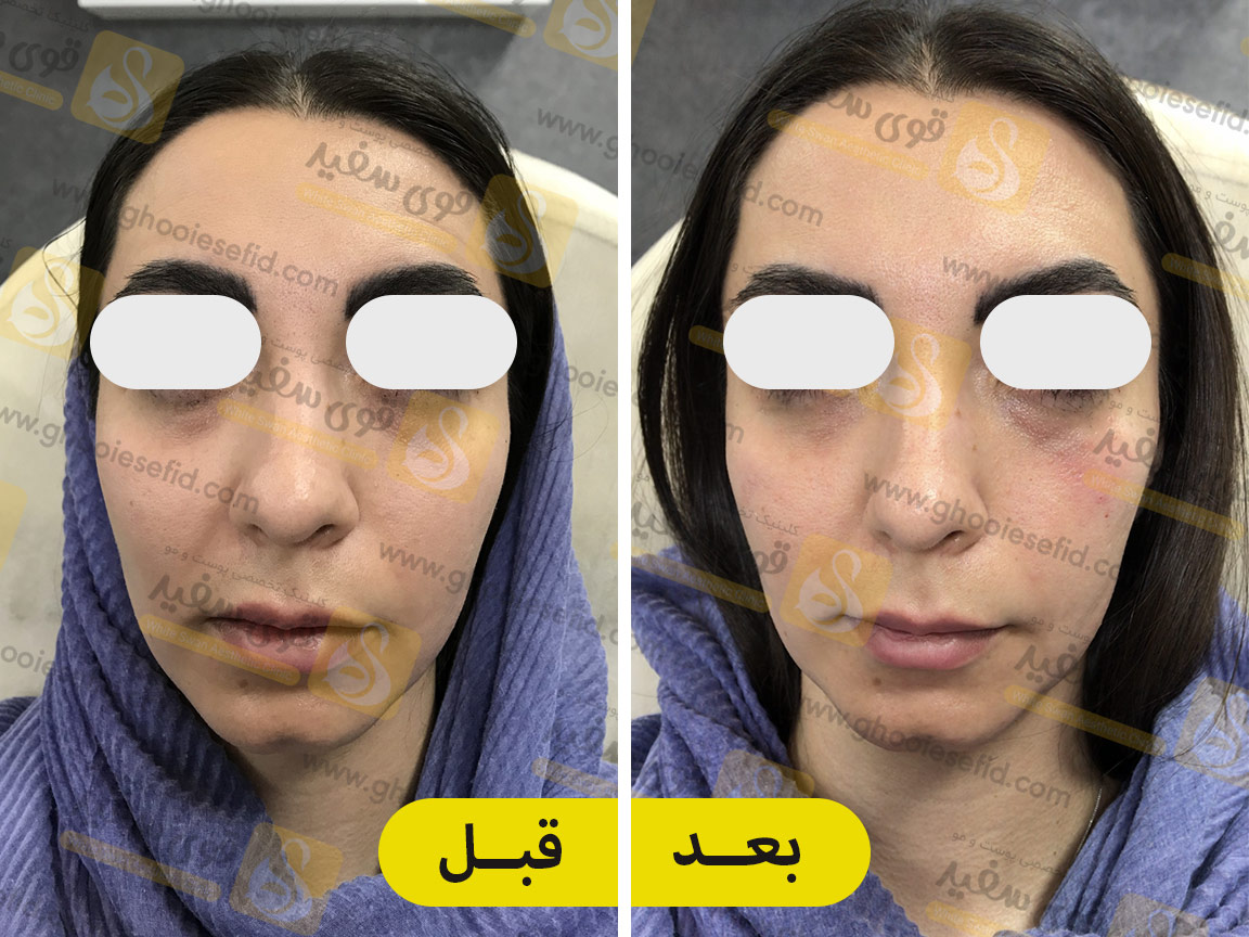 فیلر زیر چشم قبل و بعد
