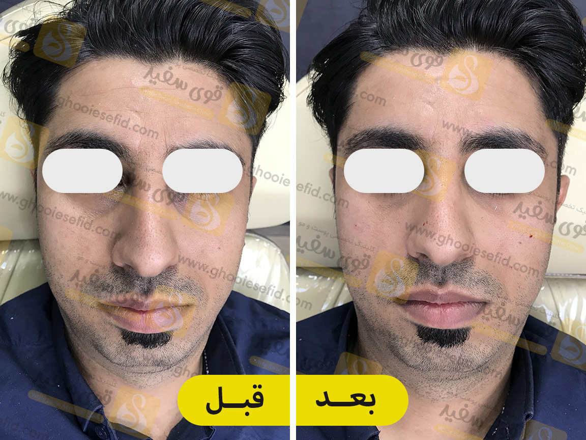 عکس فیلر زیر چشم قبل و بعد
