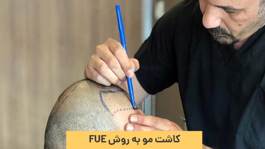 کاشت مو به روش fue