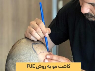 کاشت مو به روش FUE یا استخراج فولیکول مو