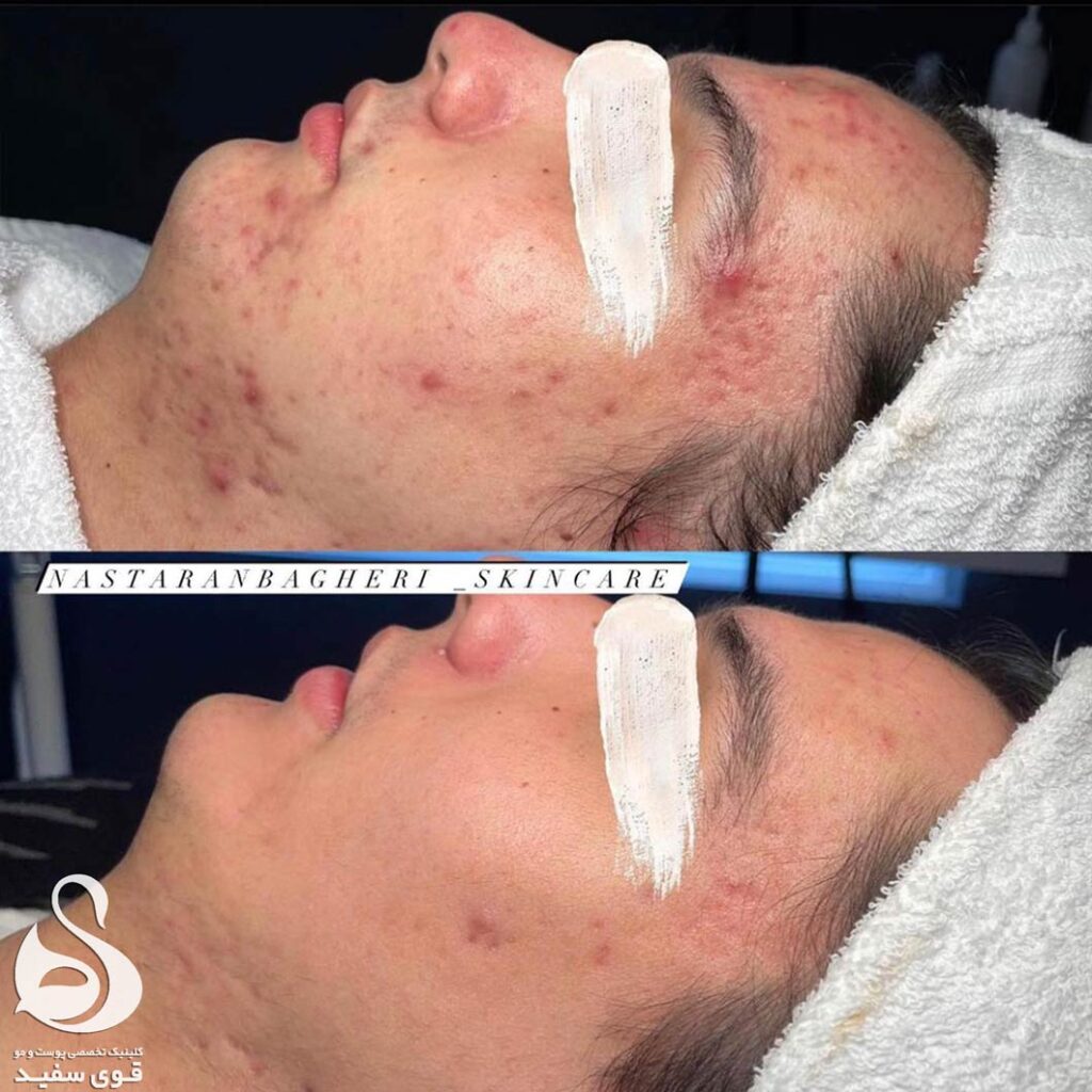 عکس قبل و بعد درمان جوش صورت در کلینیک زیبایی قوی سفید