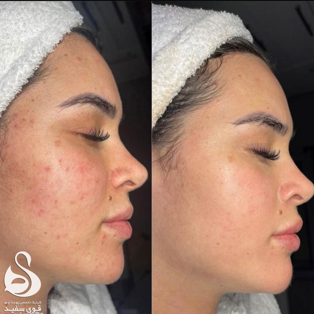 تصاویر قبل و بعد از درمان جوش صورت در کلینیک زیبایی قوی سفید
