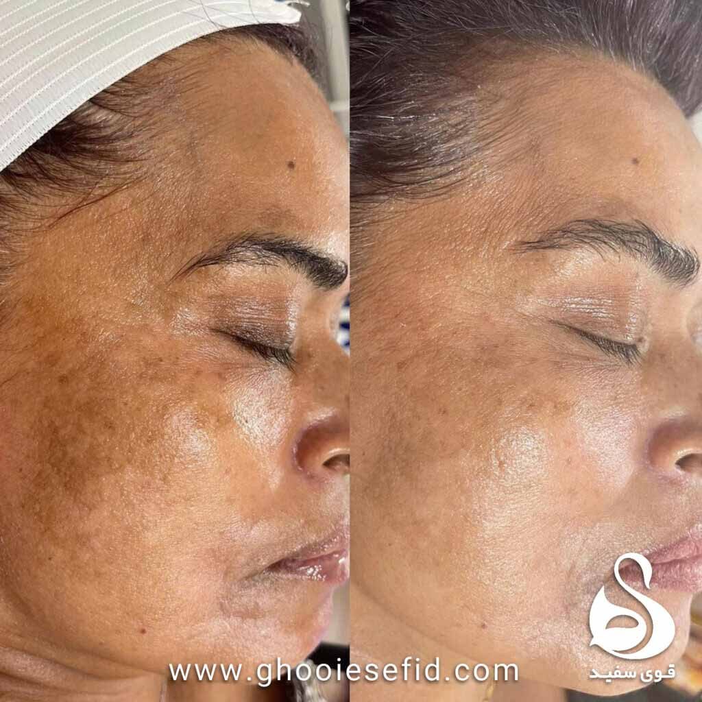 عکس قبل و بعد درمان جای جوش