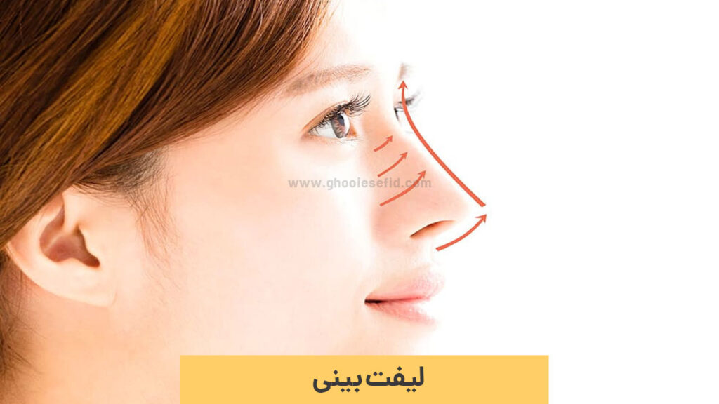 روش های لیفت بینی بدون عمل جراحی