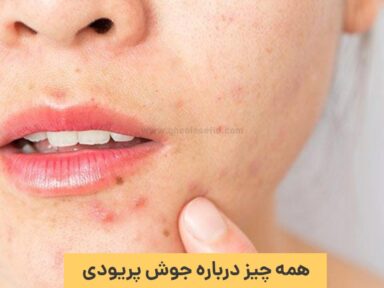 جوش پریودی؛ علت، علائم و روش های رفع جوش پریودی