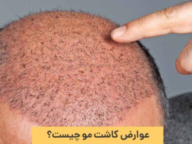 عوارض کاشت مو و روش های جلوگیری از بروز آن