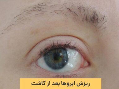 آیا ریزش ابرو بعد از کاشت طبیعی است؟