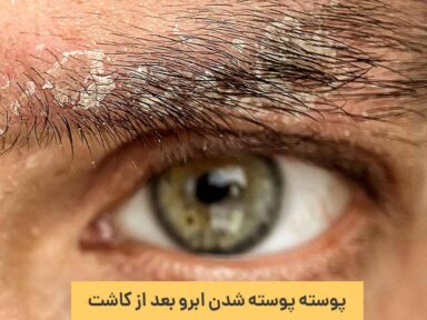 پوسته پوسته شدن ابرو بعد از کاشت؛ علت + درمان