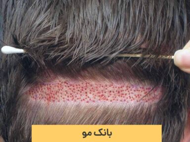 بانک مو کجاست؟ انتخاب بانک موی مناسب چه تاثیری بر کاشت مو دارد؟