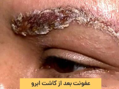 عفونت بعد از کاشت ابرو | دلایل، روش های پیشگیری و درمان