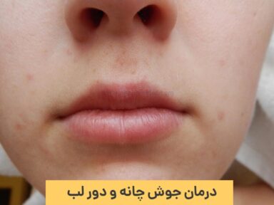 بهترین روش های درمان جوش چانه و دور لب