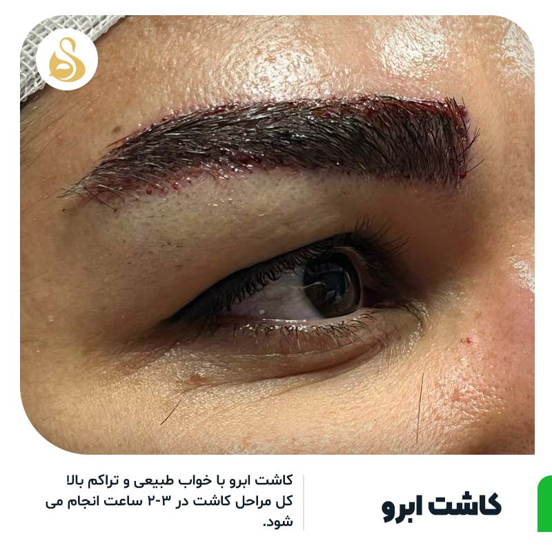 مدل کاشت ابروی پهن