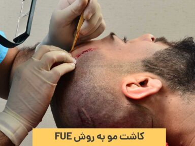 همه چیز درباره کاشت مو به روش FUE